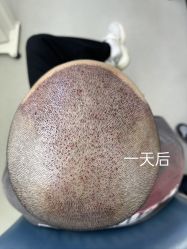 体验后-大麦微针植发全国连锁