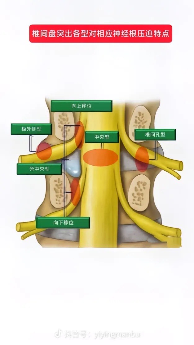 颈椎纤维环图片