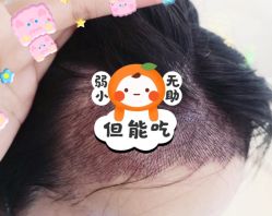 -大麦微针植发全国连锁