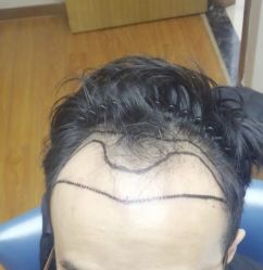 -大麦微针植发全国连锁