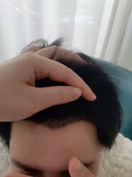 -大麦微针植发丨全国连锁