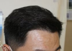 -大麦微针植发丨全国连锁