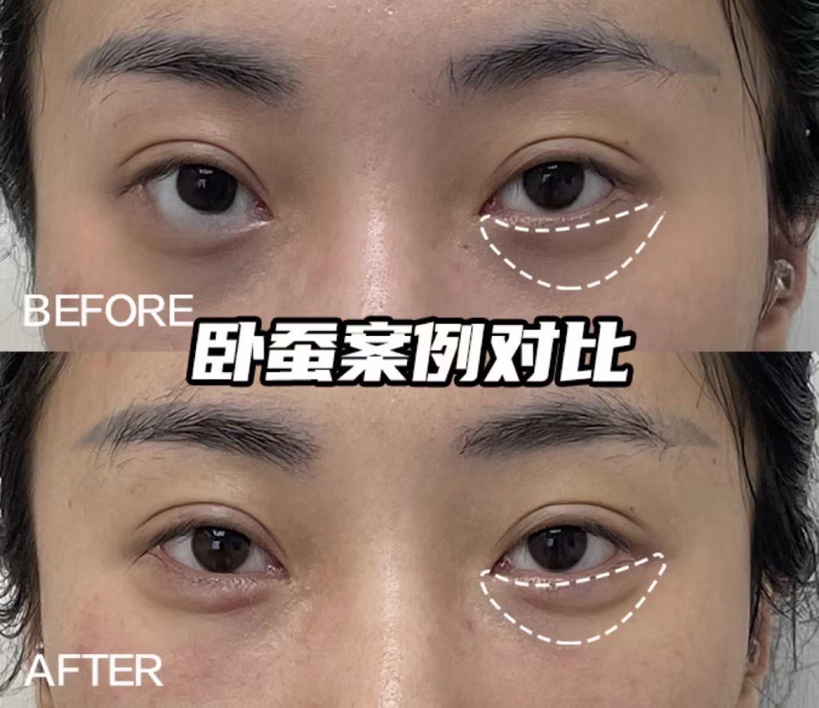 注射卧蚕有多香,显老中长庭秒变幼态脸姐妹