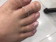 -世龙世家灰指甲·甲沟炎·跖疣护理·修脚(东江湾路店)
