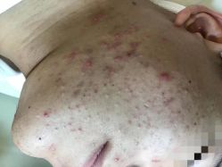 -友仟痘医生科学祛痘连锁