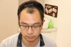 点击看大图 -大麦微针植发丨全国连锁