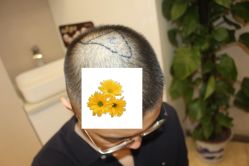 -大麦微针植发丨全国连锁