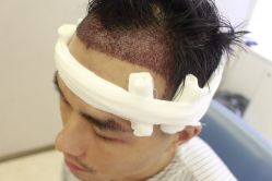 -大麦微针植发丨全国连锁