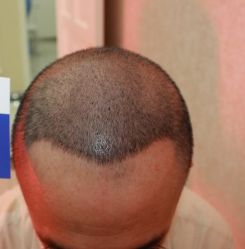 -大麦微针植发全国连锁