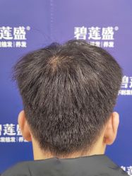 -碧莲盛·不剃发植发