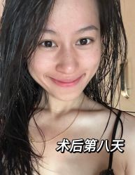 点击看大图 体验后-石家庄苏亚美联臣医疗美容医院