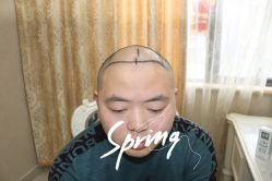 -大麦微针植发全国连锁