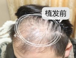 -大麦微针植发全国连锁