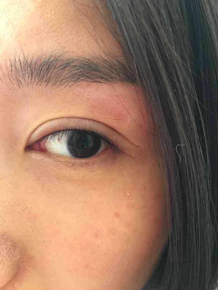 aina美颜管理中心-"今天是做美瞳线的第三天,因为眼睛有点点敏.