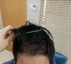 体验后-大麦微针植发丨全国连锁