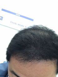 体验后-大麦微针植发丨全国连锁