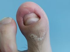 -Andrew指甲专科灰指甲·甲沟炎矫正·3D步态矫形鞋垫定制(浦三路店)