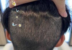 -大麦微针植发全国连锁