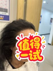 -大麦微针植发全国连锁