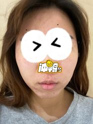 体验后-广东韩妃整形外科医院