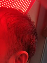 -碧莲盛·不剃发植发