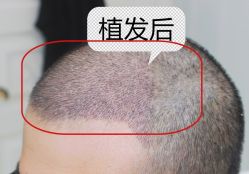 -大麦微针植发全国连锁
