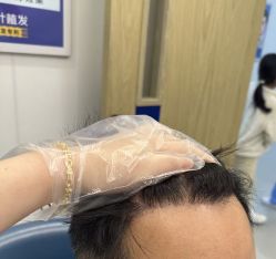 -大麦微针植发全国连锁