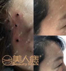 -美人痣全国连锁