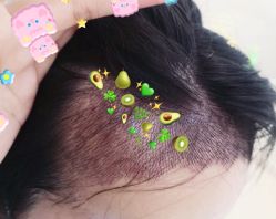 -大麦微针植发全国连锁