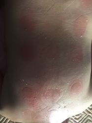 -莲芸拔罐减肥