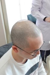 -大麦微针植发丨全国连锁