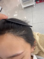-大麦微针植发丨全国连锁
