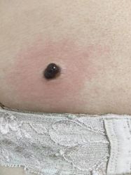 -北京美痣堂古方祛痣斑疣瘊