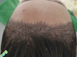 -大麦微针植发丨全国连锁