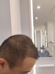 -大麦微针植发全国连锁