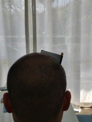 -大麦微针植发丨全国连锁