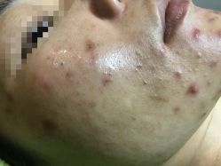 -苗医生草本科技祛痘