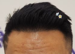 -大麦微针植发全国连锁