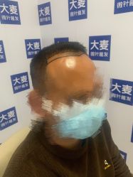 体验后-大麦微针植发丨全国连锁