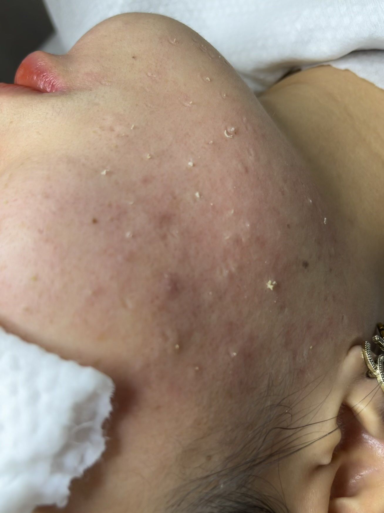 闭口痘痘怎么挤不留痕迹?