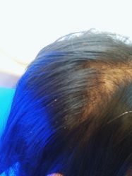 -碧莲盛·不剃发植发