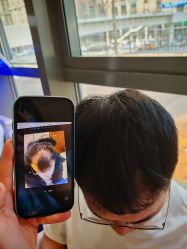 -碧莲盛·不剃发植发