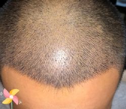 -大麦微针植发丨全国连锁