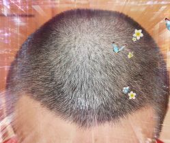 -大麦微针植发全国连锁