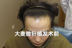 -大麦微针植发全国连锁