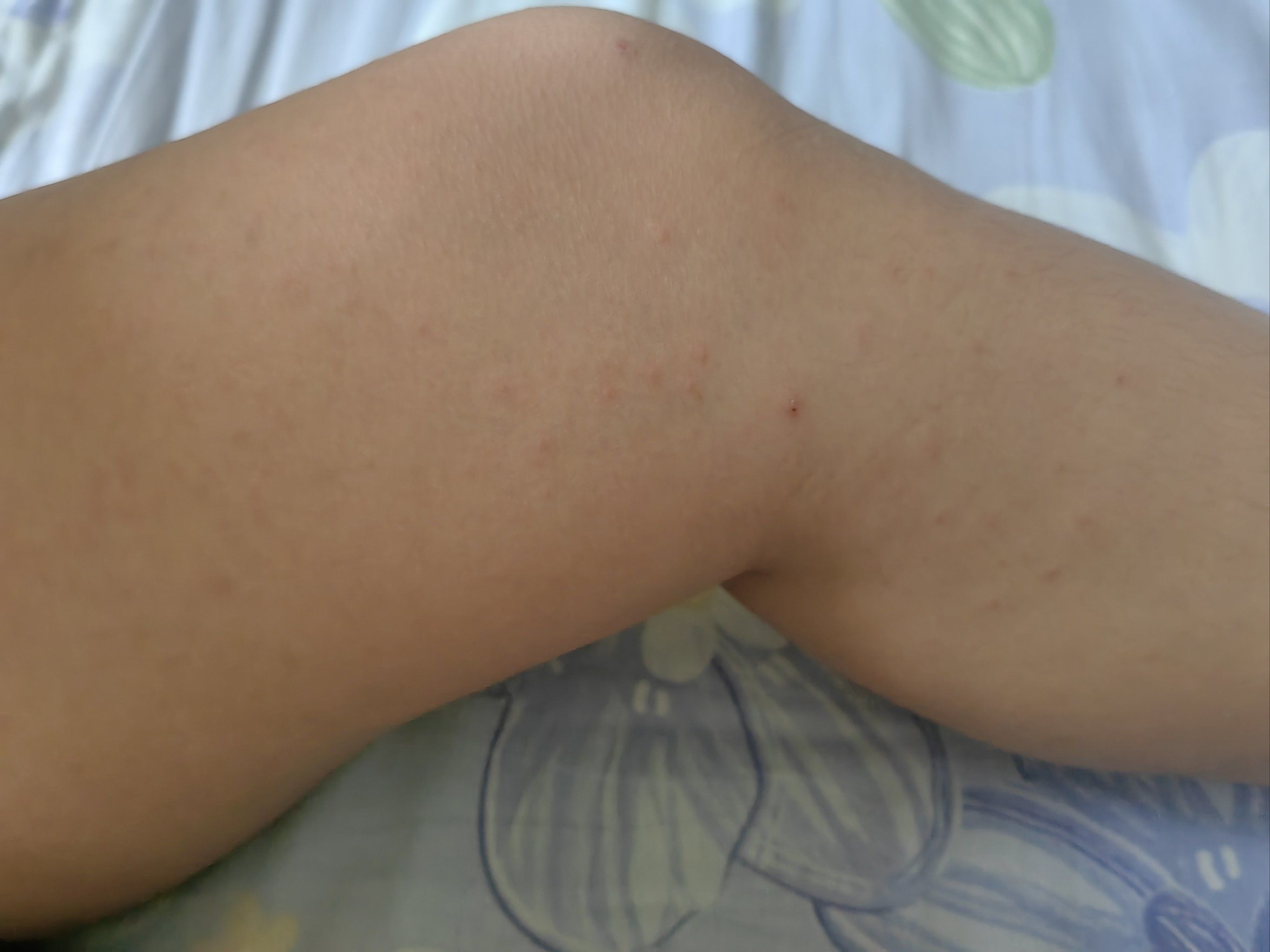 昨天玩了一天,今天早上起床孩子腿过敏起疹子,水不干净,非常差,再也不