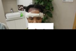 -大麦微针植发丨全国连锁