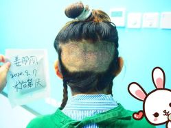 点击看大图 -大麦微针植发丨全国连锁