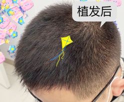 -大麦微针植发全国连锁