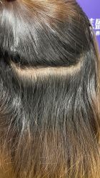 -碧莲盛·不剃发植发